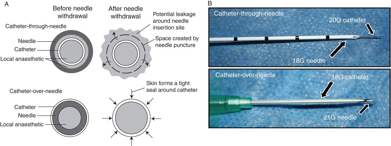 Catheter Through vs. Over Needle