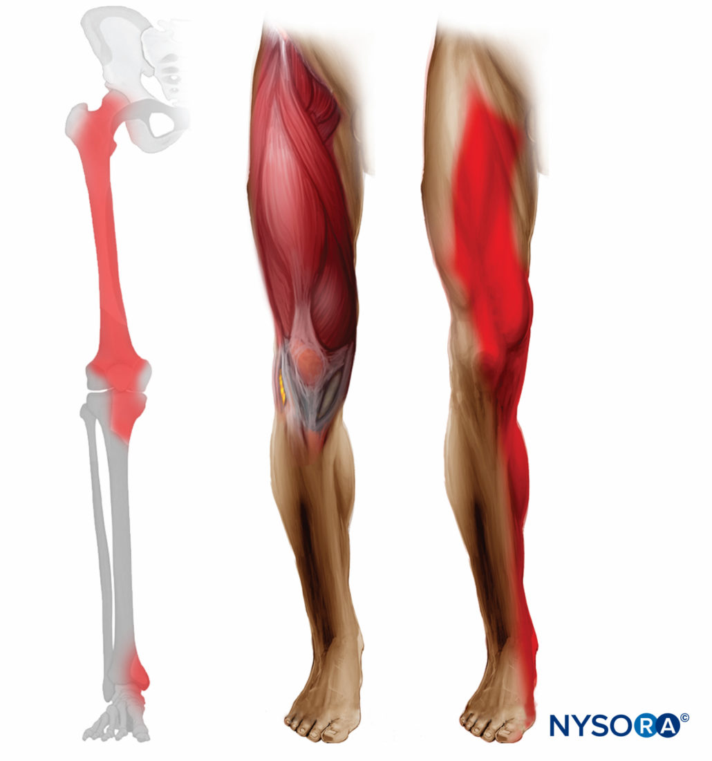 femoral-dermatome