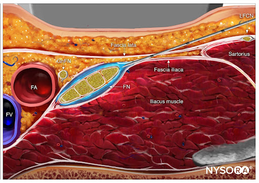 femoral-injection