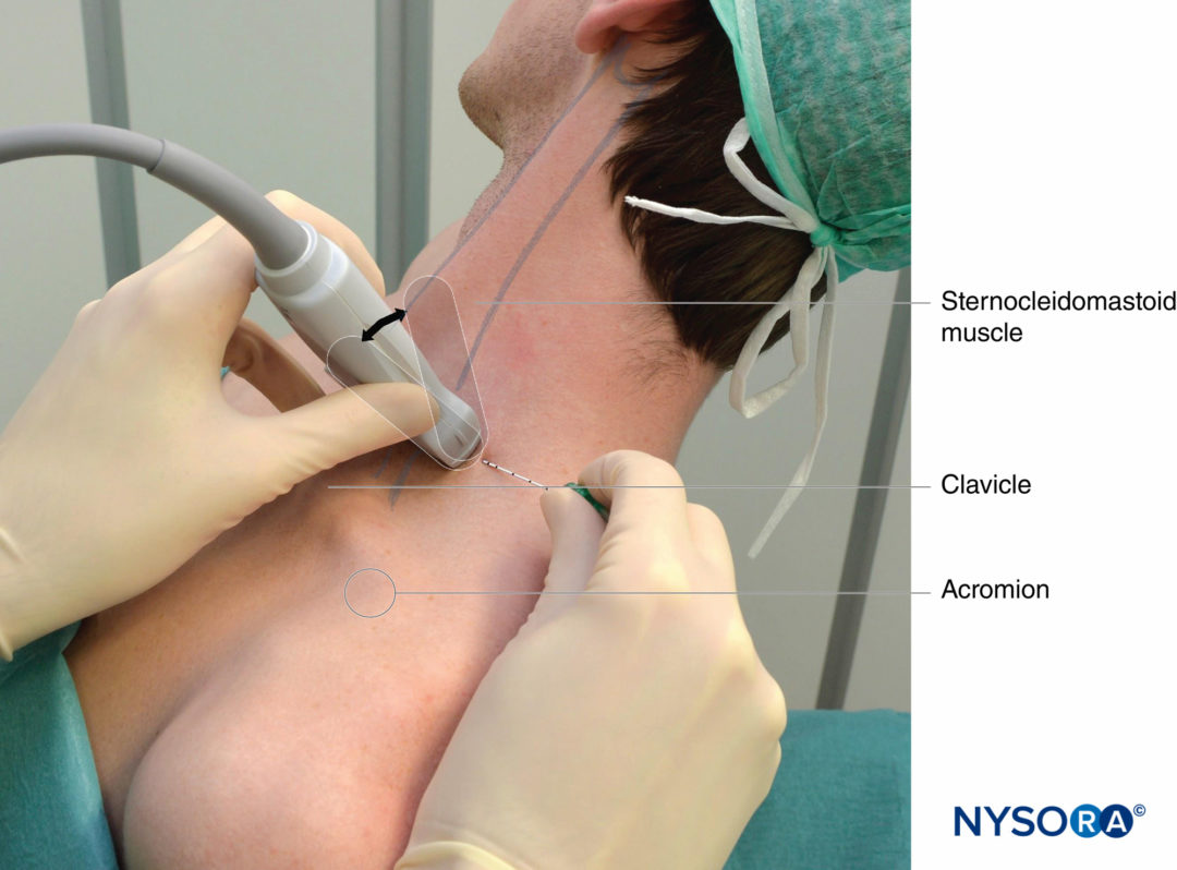 interscalene-position