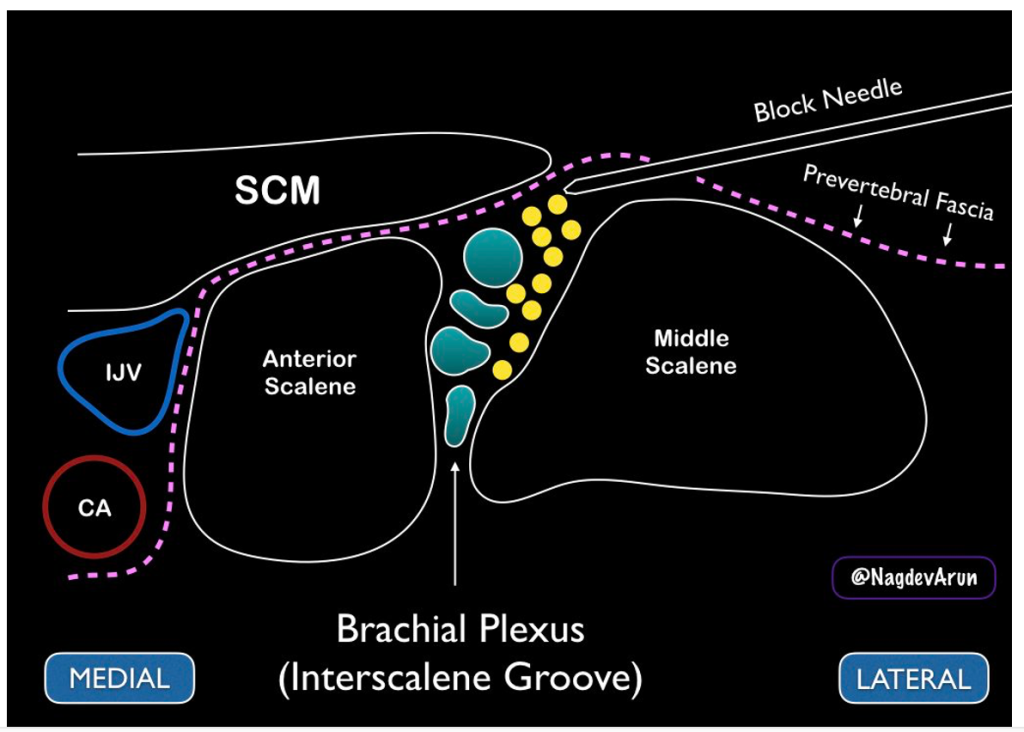 interscalene-us-diagram