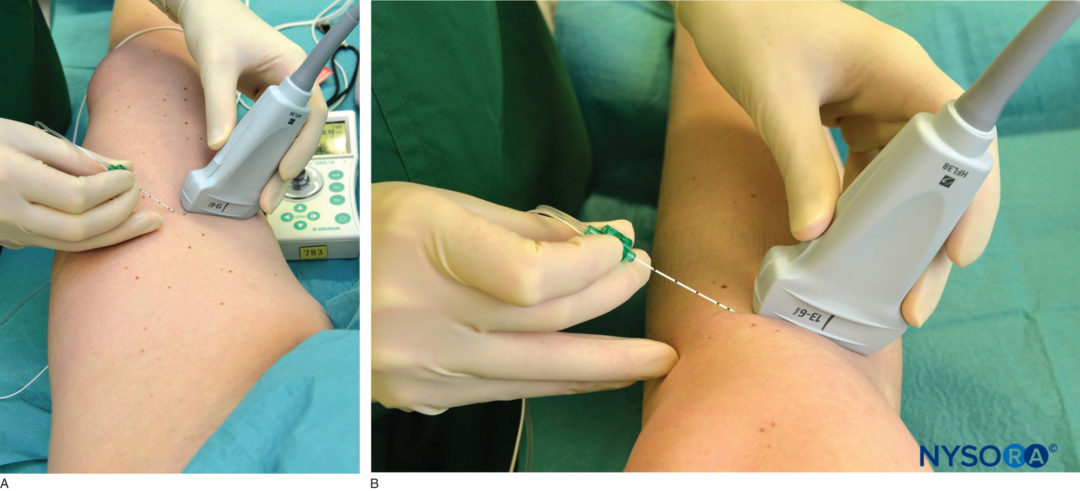 Lower Extremity Blocks UW Anesthesia Peer Talk Regional Anesthesia
