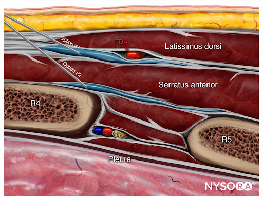 Serratus Anterior Injection
